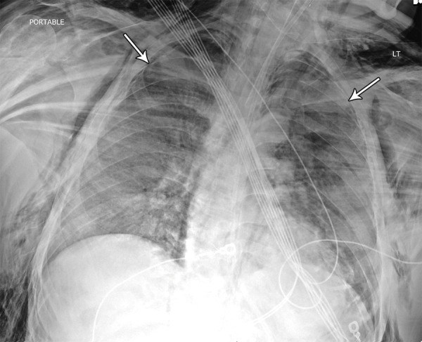 Image in 42-year-old man with no past medical history other than obesity intubated in the intensive care unit. Chest radiograph demonstrates diffuse dense opacities with small bilateral pneumothoraces (arrows) in addition to severe bilateral neck and chest wall subcutaneous emphysema. The etiology of the air leak is unknown but suspected to be related to mechanical ventilation and high positive end-expiratory pressure settings, a finding that has been previously associated with acute respiratory distress syndrome. The patient was confirmed to be positive for coronavirus disease 2019 with polymerase chain reaction testing.