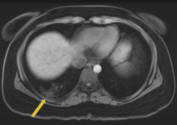 Image in 26-year-old woman with a recent history of sleeve gastrectomy complicated by splenic vein thrombosis who presented to the emergency department with left lower quadrant abdominal pain. T1-weighted axial MRI with intravenous contrast material of the abdomen and pelvis incidentally noted peripheral signal intensity abnormalities in the right lung base (arrow). The patient subsequently tested positive for coronavirus disease 2019 with polymerase chain reaction testing.