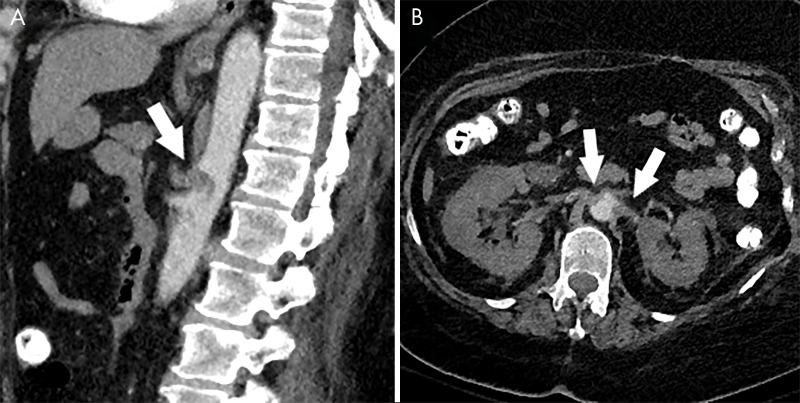 Arterial thrombosis in coronavirus disease 2019 (COVID-19). A, Sagittal CT angiogram of the abdomen in a 66-year-old woman with COVID-19 demonstrates thrombus in the celiac artery (arrow). B, Axial CT angiogram in the same patient demonstrates thrombus in both renal arteries (arrows) with associated hypoperfusion changes in both kidneys.