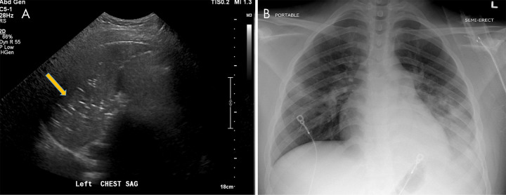 A, Lung US in a 17-year-old boy being treated for coronavirus disease 2019, on bilevel positive airway pressure in the pediatric intensive care unit, shows consolidation in the left lung with multiple echogenic foci representing “air bronchograms” (arrow). B, Chest radiograph in the same patient reveals multiple patchy consolidative pulmonary opacities most predominantly within the left lower lobe.