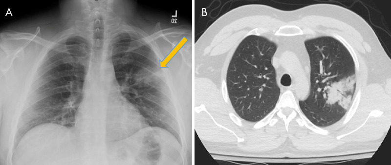 A, Chest radiograph and B, axial non–contrast-enhanced chest CT scan in a 27-year-old man with no past medical history, who presented with a fever, vomiting, and myalgias of duration 3 days, demonstrate dense consolidation in the apicoposterior segment of the left upper lobe (arrows). The patient was confirmed to be positive for coronavirus disease 2019 with polymerase chain reaction testing. This single upper lobe involvement represents an atypical pattern of disease without any associated identifying factors in the patient’s history or presentation.