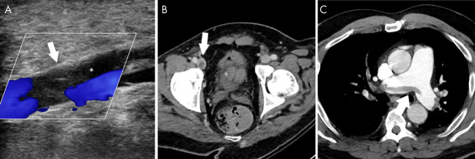 Venous thromboembolic disease in coronavirus disease 2019 (COVID-19). A, Doppler US image of the left lower extremity in a 57-year-old man with COVID-19 demonstrates nonocclusive thrombus in the popliteal vein (arrow). B, Pelvic CT scan in a 33-year-old man demonstrates nonocclusive thrombus in the right common femoral vein (arrow). C, CT chest angiogram in a 69-year-old man demonstrates saddle pulmonary embolus (arrow).