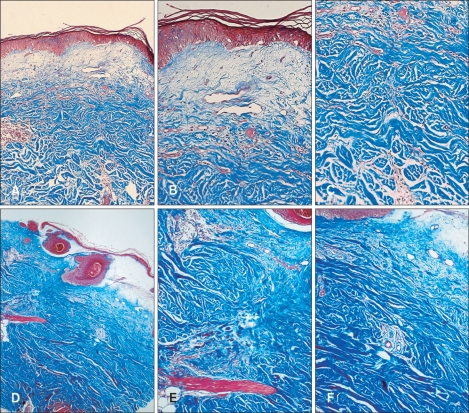 A Case Of Lichen Sclerosus Et Atrophicus Accompanying Bullous Morphea - Pmc