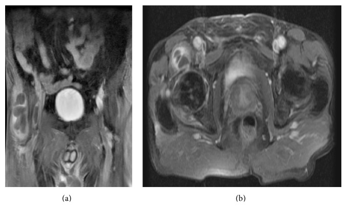 An Unusual Association: Iliopsoas Bursitis Related to Calcium ...