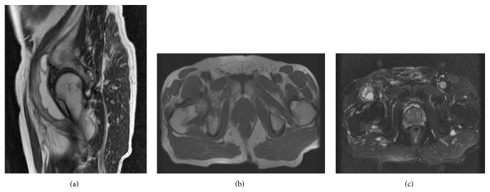 An Unusual Association: Iliopsoas Bursitis Related to Calcium ...