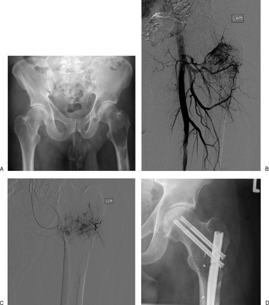 Embolization of Musculoskeletal Bone Tumors - PMC