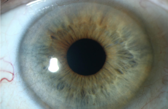 Pseudophakic corneal edema caused by Descemet membrane detachment using ...