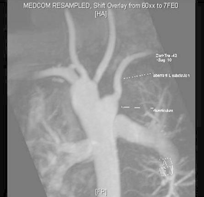 Repair of Vascular Ring with Resection of Kommerell Diverticulum and ...