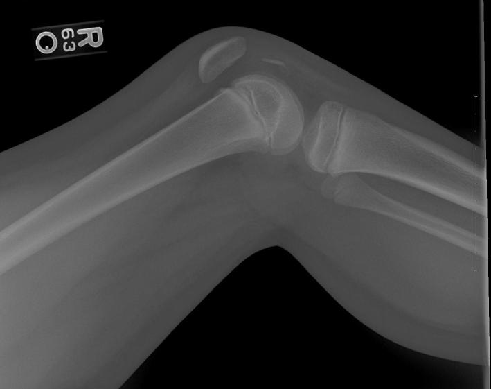 Patellar Sleeve Fracture - PMC