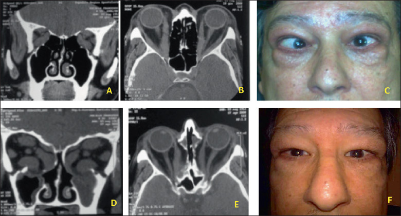 CT: computed tomography; TED: Thyroid Eye Disease.