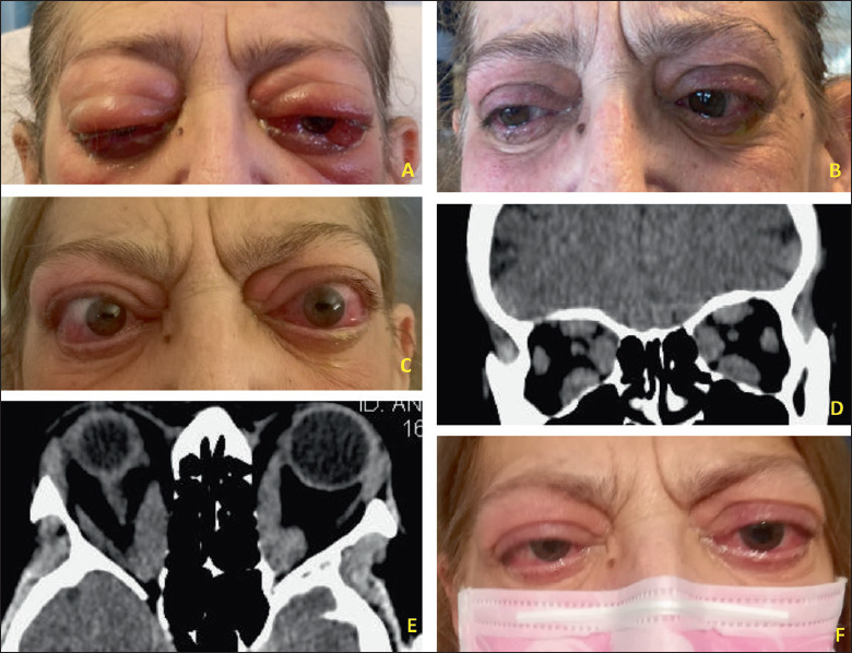 CT: computed tomography; EOMs: Extraocular muscles; GO: Graves’ Orbitopathy.