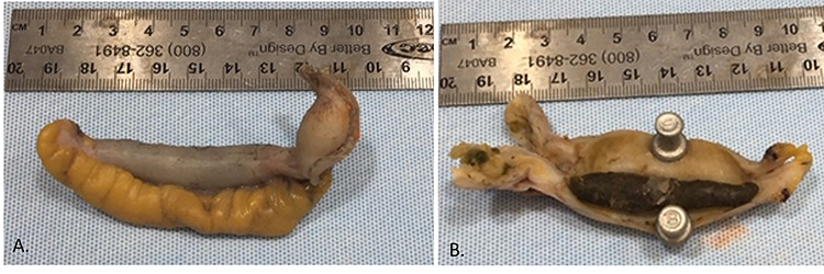 Re-assessing the role of the fecalith in acute appendicitis in adults ...