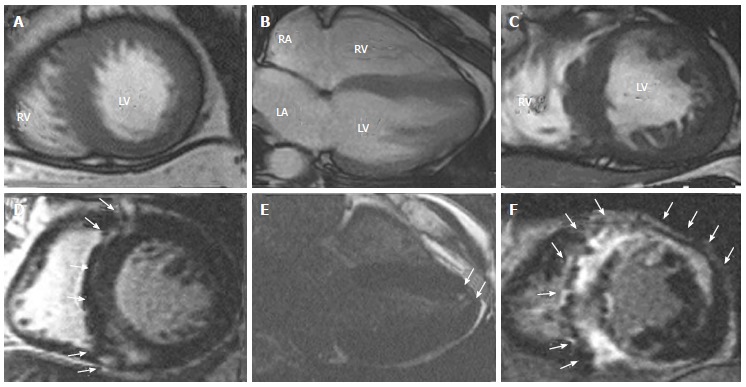 Distribution Of Late Gadolinium Enhancement In Various Types Of Cardiomyopathies Significance