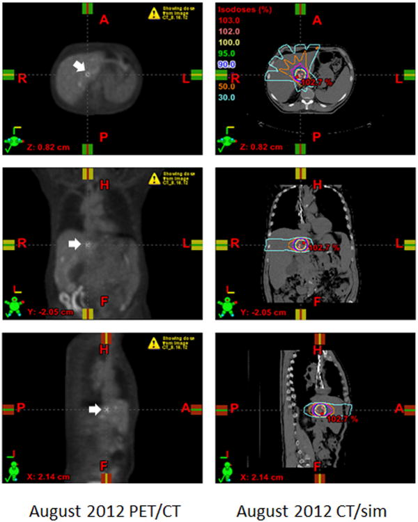 An Abscopal Response to Radiation and Ipilimumab in a Patient with ...