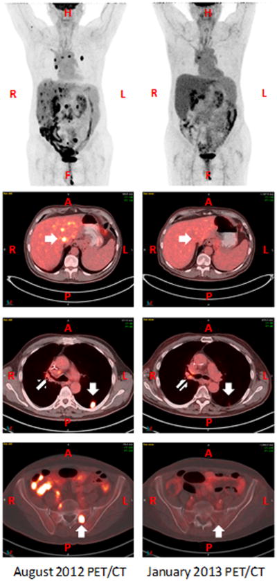 An Abscopal Response to Radiation and Ipilimumab in a Patient with ...