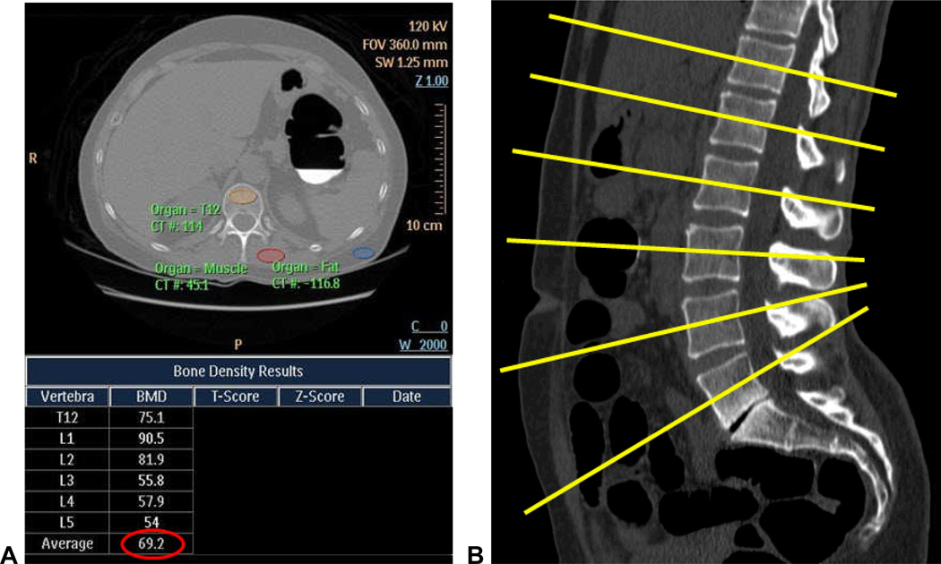 Simultaneous screening for osteoporosis at CT colonography: Bone ...