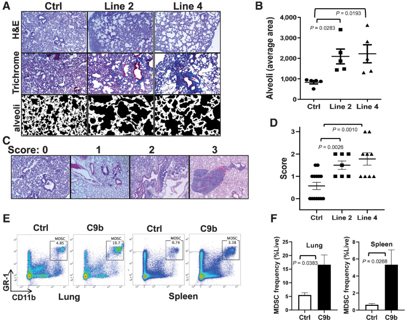 Figure. 3. Lungs of C9b mice show emphysema, fibrosis, and immune infiltration. A, H&E and trichrome staining show enlarged alveoli and increased peribronchovascular collagen deposits in line 2 and line 4 mice compared with control. Average area of alveoli (B, n = 5 per group) is measured using Image J from trichrome stained slides avoiding large vessels and bronchi (A, bottom). C and D, Scoring systems for immune aggregates and infiltrates (C, 10X) and average lung inflammation score for each group (n = 14 for control, 7 for line 2, and 9 for line 4 mice, D). E and F, Increased % of MDSCs (Gr1+/CD11b+) in lung and spleen of C9b mice (n = 3) compared with Control (n = 3) by FACS analysis. Data are means ± SEM. Adjusted P values are determined by ANOVA Tukey multiple comparison test for B and D and by unpaired t-test for F.