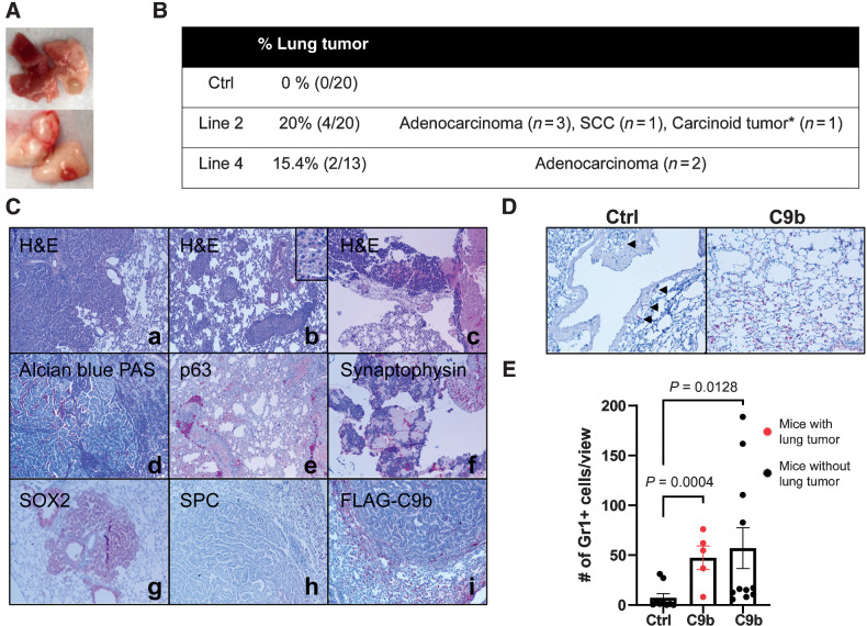 Figure 5. C9b mice develop lung tumors with aging. Macroscopic (A) and microscopic lung tumors observed in C9b mice over 21 m old of age are summarized in B. *, 1 mouse developed a carcinoid tumor and adenocarcinoma. C, Histologic analyses including H&E (a–c), Alcian Blue-PAS (d), and IHC staining with indicated antibodies (e–i) of lung tumors identified adenocarcinoma (a, d, g–i), squamous cell carcinoma (SCC; b and e), and carcinoid tumors (c and f). Images are taken at 10x magnification. Inset in b is at 40x magnification. D and E, Gr1+ cells (D, IHC) in the lung per low power field (20x, 3 views per mouse) were counted in control (n = 9) and C9b mice with (red, n = 5) or without (n = 11) lung tumors (E). Data are means ± SEM. Adjusted P values are determined by ANOVA with Tukey multiple comparison test.