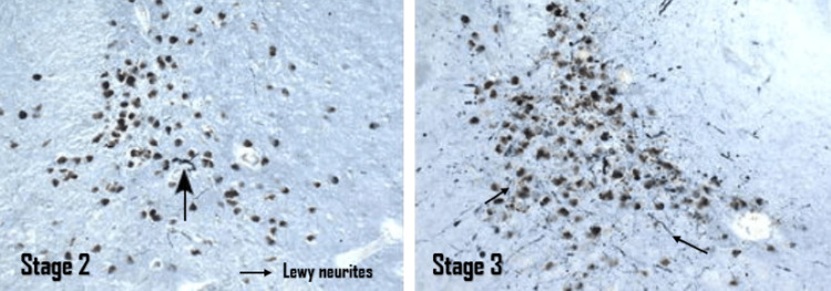 Parkinson’s Neuropathology Puzzle: A Systematic Review Uncovering the ...