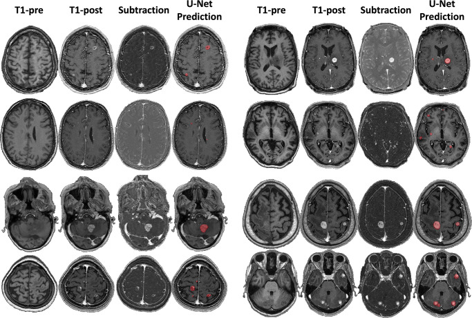 Example U-Net–predicted segmentations. Eight example MRI studies with axial T1 precontrast (T1-pre), T1 postcontrast (T1-post), and subtraction images, with example segmentations overlaid on the T1-post images (U-Net prediction).