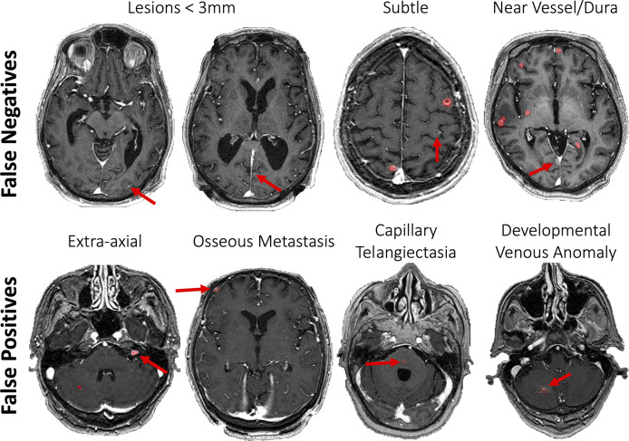 Example false-negative and false-positive findings. False-negative metastases (top row) were typically smaller than 3 mm or had other challenging characteristics, such as a subtle enhancement pattern or close proximity to the dura or prominent vessels. False-positive findings included calvarial metastases, as well as benign lesions, such as schwannomas or vascular lesions, including capillary telangiectasias and developmental venous anomalies.