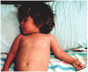 Box 2 | Measles – the disease