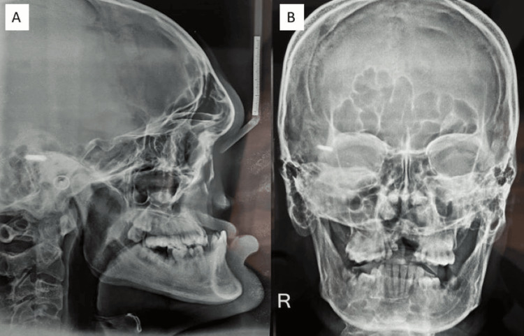 Progressive Strategy for Congenitally Missing Anteriors in Binder ...