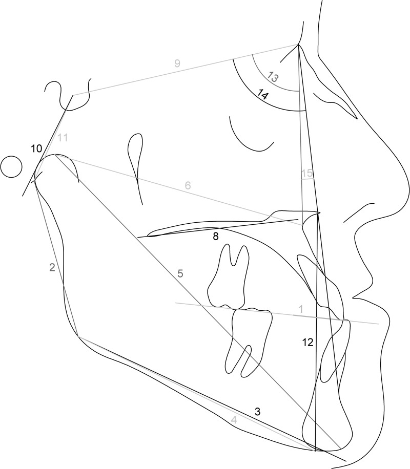 Figure 1. Linear and angular measurements. 1. Wits appraisal. 2. Ramus height (articulare-gonion; Ar-Go). 3. Corpus length (gonion-pogonion′; Go-Pog′). 4. Mandibular length (gonion-menton; Go-Me). 5. Effective length of mandible (condylion-pogonion; Co-Pog). 6. Effective midface length (condylion-A point; Co-A). 7. Maxillomandibular difference. 8. Maxillary length (A point′-pterygomaxillary point′; A′-Ptm′). 9. Sella-nasion (S-N). 10. Sella-basion (S-Ba). 11. Sella-articulare (S-Ar). 12. Lower face height (anterior nasal spina-menton; ANS-Me). 13. SNA angle. 14. SNB angle. 15. ANB angle.