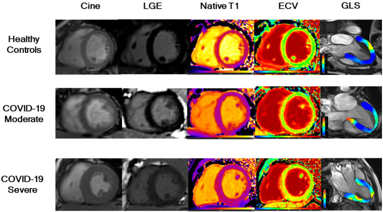 Examples of cardiac MRI in participants recovered from COVID-19 and healthy controls. Short-axis SSFP cine, corresponding phase sensitive inversion recovery (PSIR) late gadolinium enhancement (LGE), native T1 maps, extracellular volume (ECV) maps, and global longitudinal strain (GLS) of three groups (Healthy Control, participants with moderate COVID-19, and participants with severe COVID-19). A 41-year-old healthy man (control) (first row) with negative LGE, normal global native T1 (1161ms), global ECV (27%), and GLS (-17.2%). A 66-year-old woman (second row) with moderate COVID-19 and negative LGE, normal global native T1 (1139 ms), elevated global ECV (31%) and reduced GLS (-12.6%). A 44-year-old man (third row) with severe COVID-19 and focal LGE in the left ventricular septal segment. Native T1 (1216 ms) was increased, ECV values were elevated (34%) and LGS was lower (-9.1%). A moderate case is defined as a confirmed case with fever, respiratory symptoms, and radiographic evidence of pneumonia, while a severe case is defined as a moderate case with dyspnea or respiratory failure.