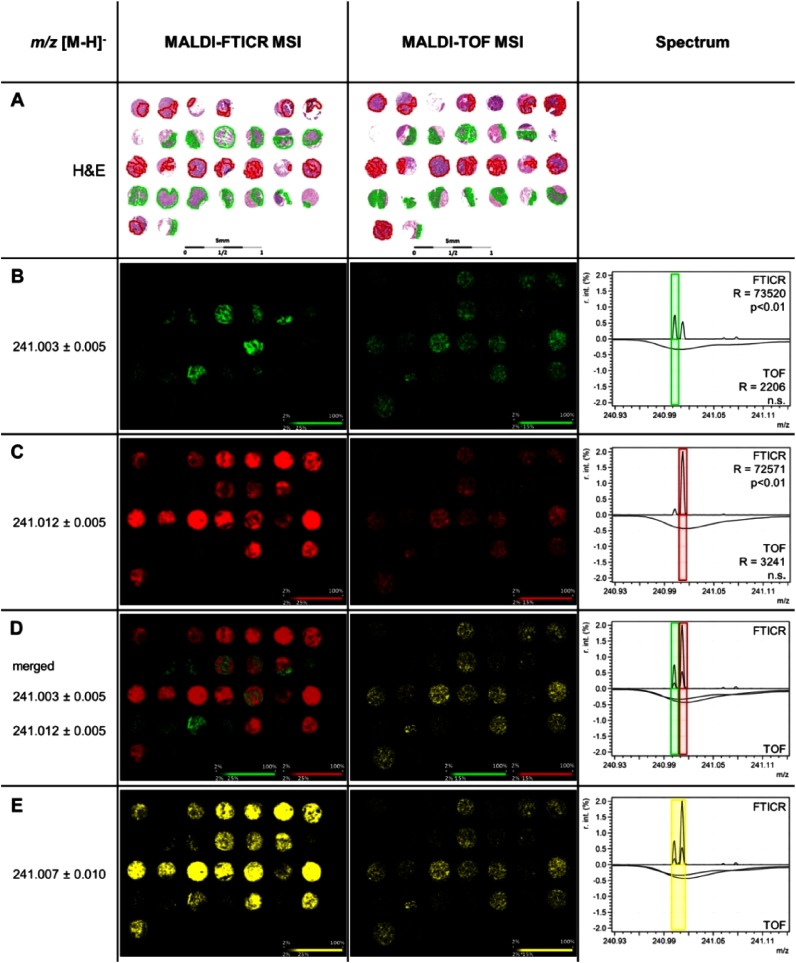 Fig. 1. (A) Hematoxylin and Eosin (H&E) stain of a colon tissue microarray with annotated normal epithelium regions (green) and tumor regions (red). Mass spectra and ion distribution maps show differences in significance levels and localization of the ions (B) m/z 241.003±0.005 (green) and (C) m/z 241.012±0.005 (red) with MALDI-FTICR and MALDI-TOF MSI. (D) In high-mass resolution imaging, the two analytes are clearly defined as different molecular components discriminating normal colon epithelium and tumor in MALDI-FTICR MSI. Imaging with lower resolution combined signals making it appear as a single peak. In the TOF image, a superimposition of green and red results in yellow demonstrating ion co-localization. (E) Simulation of the TOF image by the selection of a wider bin width combining both peaks (m/z 241.007±0.010) in FTICR spectrum. Reprinted with permission from A. Buck, B. Balluf, A. Voss, R. Langer, H. Zitzelberger, M. Aichler, A. Walch, How Suitable is Matrix-Assisted Laser Desorption/Ionization-Time-of-Flight for Metabolite Imaging from Clinical Formalin-Fixed and Paraffin-Embedded Tissue Samples in Comparison to Matrix-Assisted Laser Desorption/Ionization-Fourier Transform Ion Cyclotron Resonance Mass Spectrometry?, Anal. Chem. (2016) 88, 10, 5281–5289. Copyright © 2016 American Chemical Society.