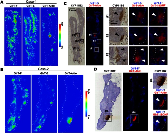 Fig. 4. (A, B) Distribution of GirT-steroids in healthy human adrenal glands. Whole (A, B, C, E) and enlarged (D, F) views of CYP11B2 immunoreactivity and detection of GirT-Cortisol (GirT-F, m/z 387.2), GirT-Cortisone (GirT-E, m/z 385.2), GirT-Aldosterone (GirT-Aldo, m/z 397.2), and GirT-18-hydroxycortisol (GirT-18-OHF, m/z 413.2) by MALDI MSI. Reprinted with permission from E. Takeo, Y. Sugiura, T. Uemura, K. Nishimoto, M. Yasuda, et al., Tandem Mass Spectrometry Imaging Reveals Distinct Accumulation Patterns of Steroid Structural Isomers in Human Adrenal Glands, Anal. Chem. (2019) 91, 14, 8918–8925. Copyright © 2019 American Chemical Society.