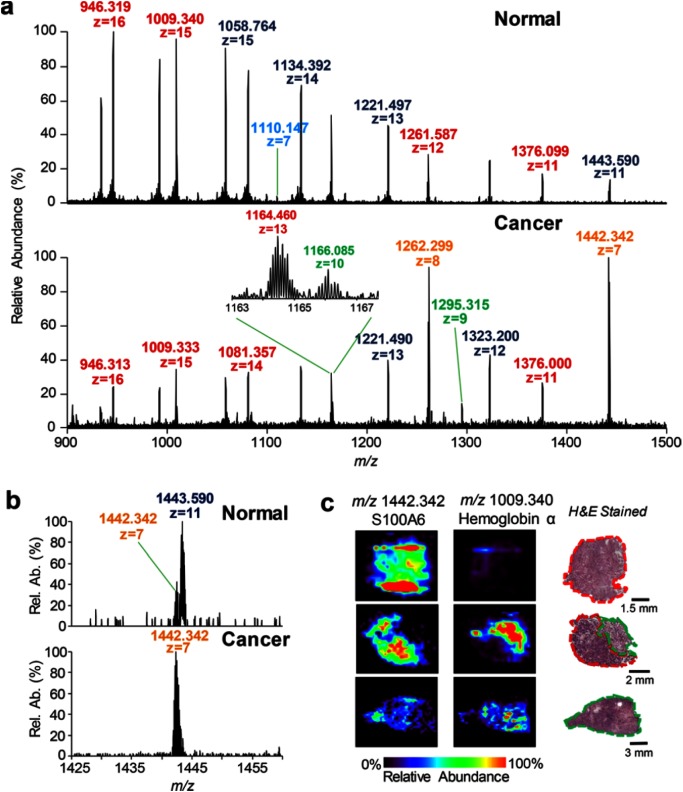 Fig. 9. Protein DESI-MS spectra of normal and high-grade serous ovarian cancer ovarian tumor with optimized FAIMS parameters. Mass spectra are averages of 10 scans. Different charge states of the same protein species are denoted by same-colored labels. (b) Zoomed in mass spectra of normal and high-grade serous ovarian cancer samples, highlighting the observance of m/z 1442.339, identified as S100A6, within the cancer tissue. (c) DESI-MS ion images obtained from normal, pure cancer, and mixed normal/cancer ovarian tissue sections. Ion images are on the same scale. H&E stained images are of a serial ovarian tissue sections as protein conditions are not histologically compatible. Reprinted from K. Y. Garza, C. L. Feider, D. R. Klein, J. A. Rosenberg, J. S. Brodbelt, L. S. Eberlin, Desorption Electrospray Ionization Mass Spectrometry Imaging of Proteins Directly from Biological Tissue Sections, Anal. Chem. (2018), 90, 13, 7785–7789 with permission. Copyright © 2018 American Chemical Society.