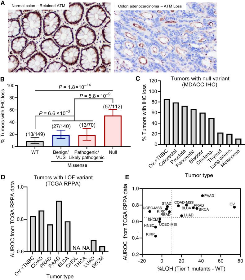 Figure 4. Relationship between ATM variant status and ATM protein expression. A, Example images of ATM IHC staining showing retained protein expression in normal colon tissue (left) vs. loss of protein (LOP) in colon adenocarcinoma (right) using ATM clone Y170 antibody. LOP is defined as 100% loss of staining in tumor cell nuclei. B, Association between complete LOP (y axis) and ATM variant status (x axis) in N = 471 patient tumors. C and D, The relationship of LOP (y axis; C) and tumors with known deleterious, null variants (D) is variable by tissue type. E, Correlation of ATM LOP and ATM loss of heterozygosity (LOH) in tumors with Tier 1 ATM variants (protein-altering, deleterious variants) across tumor tissue type.