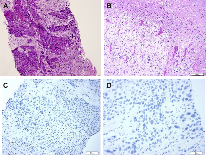 Pathologic Complete Response After Chemoradiation Of A Massive Primary 