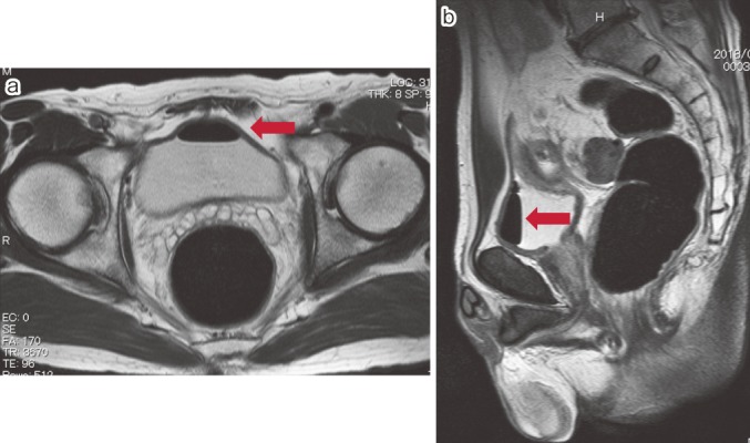 Laparoscopic surgery for colovesical fistula associated with sigmoid ...