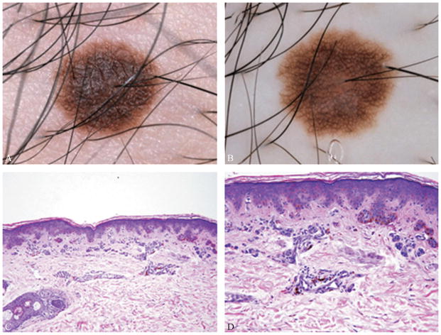 Biologically distinct subsets of nevi - PMC