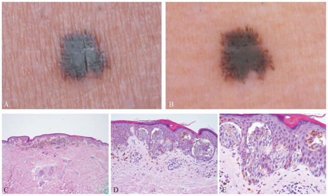 Biologically distinct subsets of nevi - PMC