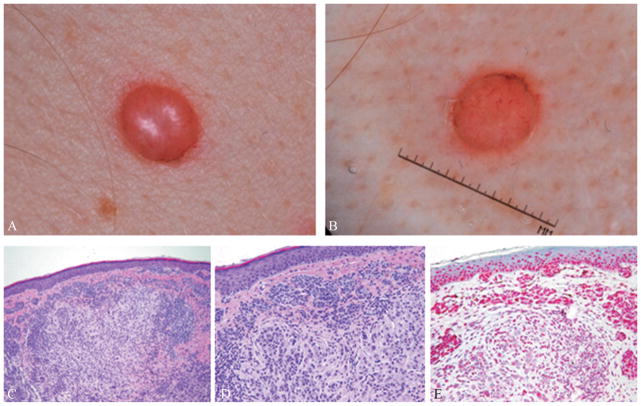 Biologically distinct subsets of nevi - PMC