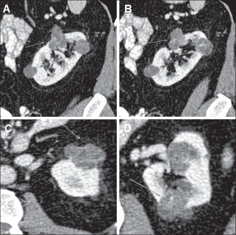 Bosniak classification of renal cystic lesions according to ...