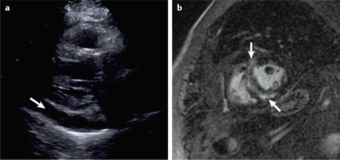 Box 1 Laboratory and imaging abnormalities in COVID-19