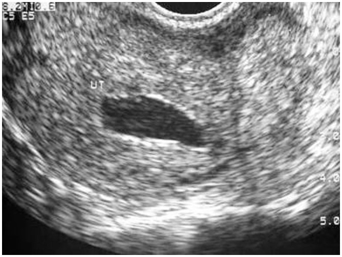 MR Imaging for Ectopic Pregnancy - PMC