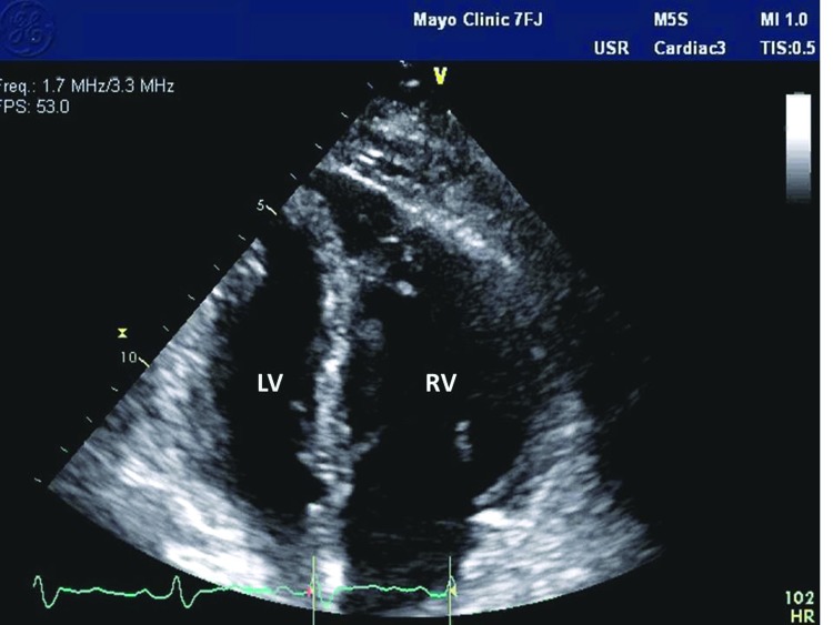 McConnell's echocardiographic sign in acute pulmonary embolism: still a ...