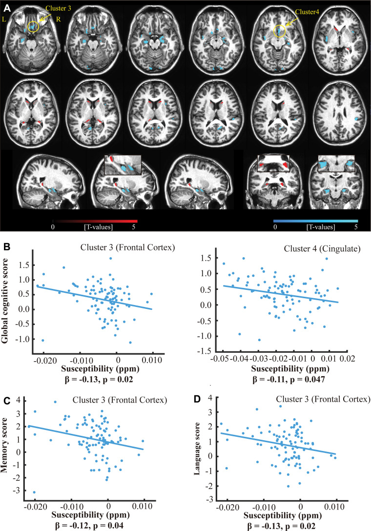 A, Overlay of regions with positive (red) and negative (cyan) correlations between iron load (ie, quantitative susceptibility mapping) and β-amyloid plaque load (PET distribution volume ratio) in all participants of the PET group (n = 97) with family-wise error−corrected cluster level significance of P value less than .05 (combined with an uncorrected voxel-level significance P < .001) and a cluster size threshold of 200 voxels on example axial slices of anatomic MRI (top two rows) and sagittal and coronal slices showing the hippocampus (bottom row). B, Scatterplot of the adjusted response data and adjusted response function of the multiple linear regression model between global cognitive composite score and susceptibility values in two clusters (marked by arrows in A), in which the cognitive composite score negatively correlates with tissue susceptibility values. Similarly, negative associations were observed between tissue susceptibility values in the frontal cortex cluster and, C, episodic memory scores and, D, language scores. All cognitive scores are continuous variables and have z-score per unit. The reported β values are standardized coefficients.