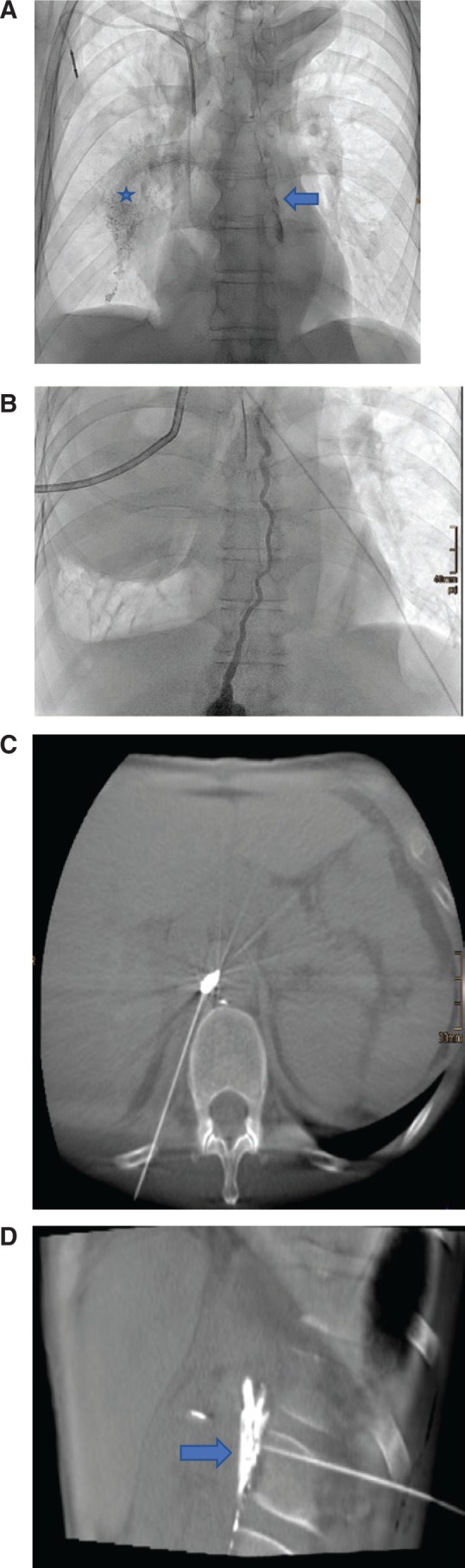 Ultrasound-guided Lymphangiography And Interventional Embolization Of 