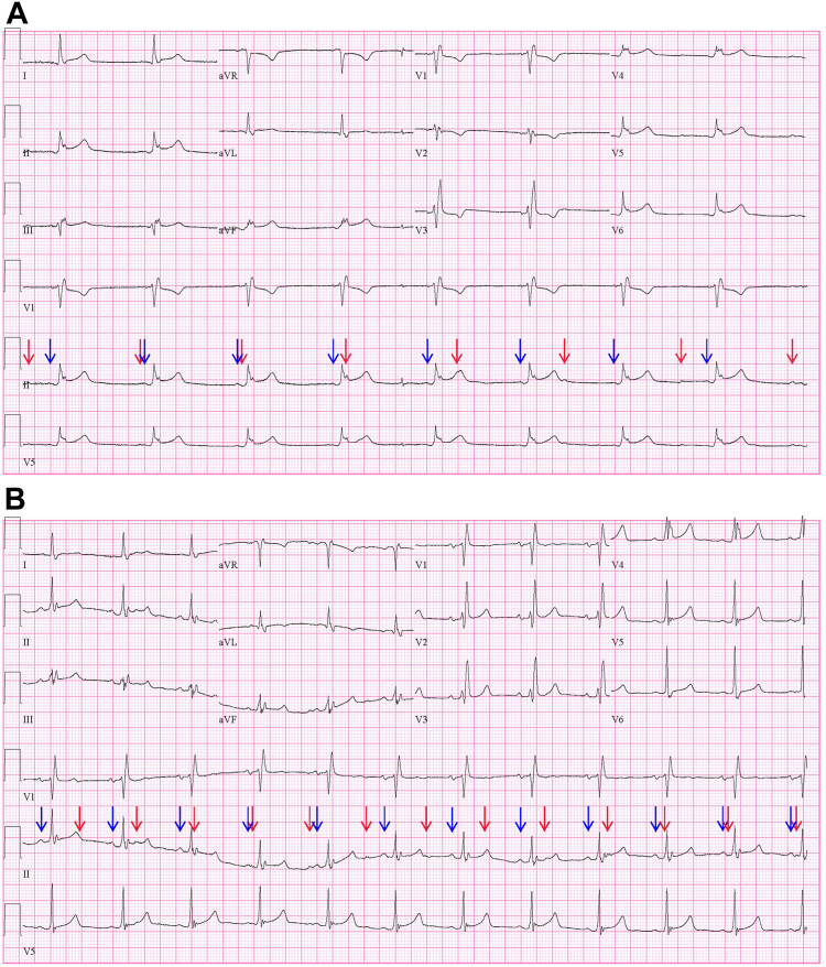 First Reported Dual-chamber Leadless Pacemaker In A Patient With 