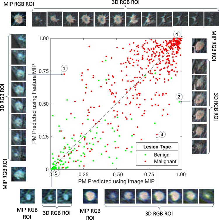 A diagonal classifier agreement plot between the image maximum intensity projection (MIP) and feature MIP methods. The x-axis and y-axis denote the probability of malignancy (PM) scores predicted by the image MIP classifier and feature MIP classifier, respectively. Each point represents a lesion for which predictions were made. Points along or near the diagonal from bottom left to top right indicate high classifier agreement; points far from the diagonal indicate low agreement. The insets are the MIP regions of interest (ROIs) and three-dimensional (3D) ROIs, which served as convolutional neural network inputs for the image MIP and feature MIP methods, respectively, of extreme examples for which using feature MIP resulted in more accurate predictions than using image MIP (lesions 1–2), for which using image MIP resulted in more accurate predictions than using feature MIP (lesion 3), and for which the two methods both predict accurately (lesions 4–5). Lesion 1 is an invasive micropapillary carcinoma, lesion 2 is fibromatosis, lesion 3 is a grade II invasive ductal carcinoma, lesion 4 is a grade II invasive ductal carcinoma, and lesion 5 is a nonmass enhancement fibroadenoma. RGB = red, green, and blue.