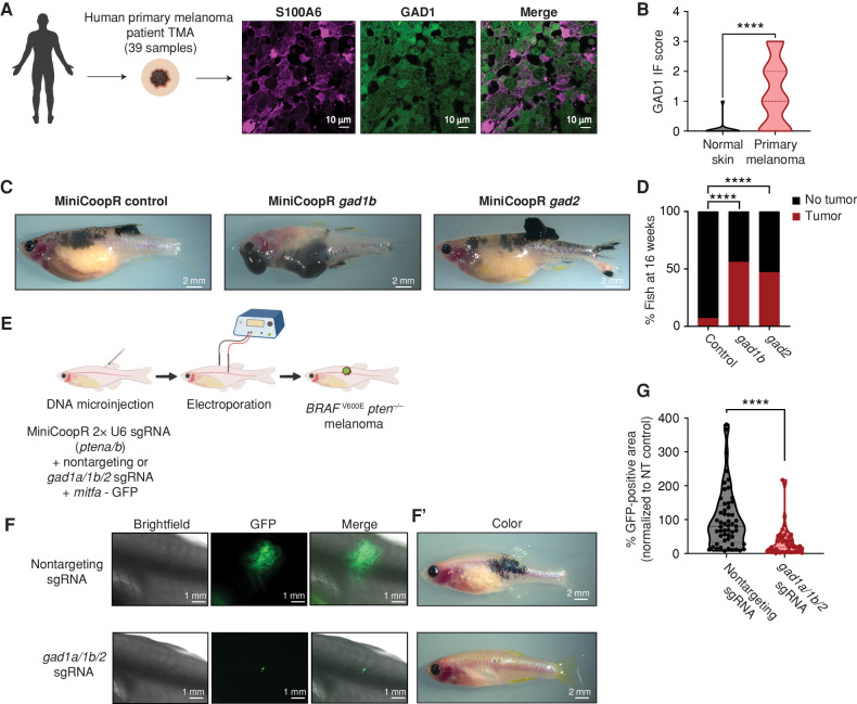 Figure 5. GABAergic signaling is protumorigenic in melanoma. A, Representative image of a patient primary melanoma sample from a primary melanoma TMA with immunostaining for S100A6 (melanoma marker) and GAD1 (GABA marker). Individual cells are pseudocolored as indicated. Left schematic created using BioRender.com. B, Violin plots of immunofluorescence (IF) score and quantification of GAD1 immunostaining in primary melanoma tumor samples and normal skin. Data represent samples from n = 30 primary melanoma patients and n = 9 normal skin; P values generated by unpaired t test with Welch correction; ****, P < 0.0001. C, Representative images of 16-week-old zebrafish with the genotype (mitfa−/− p53−/− mitfa:BRAFV600E) in the casper background injected with MiniCoopR rescue plasmids showing control (GFP) or gad1b- and gad2-overexpressing tumors. D, Quantification of melanoma incidence expressed as percentage of fish with tumors in 16-week-old zebrafish overexpressing GFP or gad1b or gad2 under a melanocyte-specific promoter. Data represent n = 55 control (GFP) fish, n = 53 gad1b, and n = 63 gad2 fish pooled from 3 biological replicates. P values generated by the chi-squared test; ****, P < 0.0001. E, Schematic representation of the TEAZ-based loss-of-function system in zebrafish to knockout GABA synthesis genes. Plasmids expressing MiniCoopR, mitfa:Cas9, and sgRNAs targeting pten were coelectroporated with plasmids expressing nontargeting or gad-targeting sgRNAs to generate control (nontargeting) or gad knockout BRAFV600E pten−/− melanomas in vivo. (Created using BioRender.com.) F and F’, Representative images of four different transgenic fish electroporated with melanocyte-specific Cas9 and a nontargeting sgRNA or gad1a/gad1b/gad2 sgRNAs, showing differences in both fluorescence area (F) and pigmented melanocyte area (F’) 6 weeks after electroporation. G, Quantification of tumor area calculated as GFP-positive area and normalized to the nontargeting (NT) control plasmid group. Data represent 53 nontargeting sgRNA fish and 46 gad1a/1b/2 sgRNA fish pooled from 3 biological replicates. Error bars, SD; P values generated by Mann–Whitney test; ****, P < 0.0001.