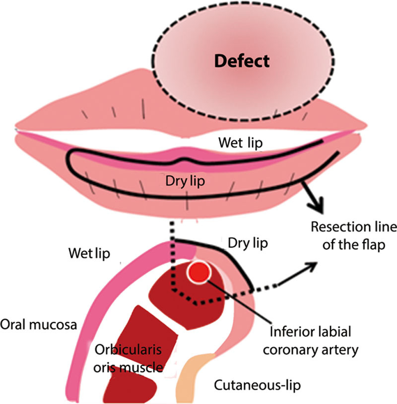 Medial Upper Lip Vermillion Reconstruction with a Labial Artery-based ...