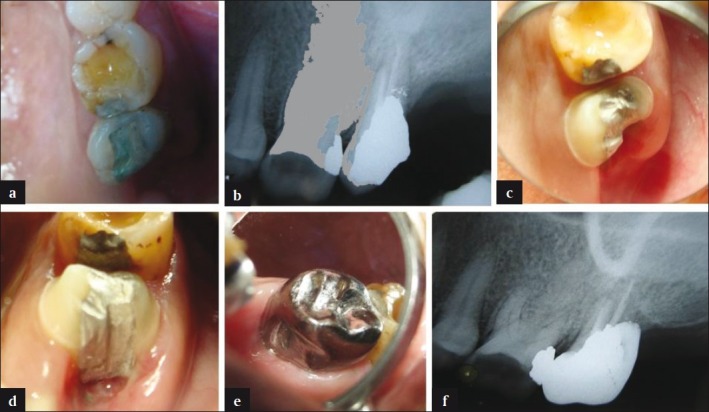 Root resection under the surgical field employed for extraction of ...