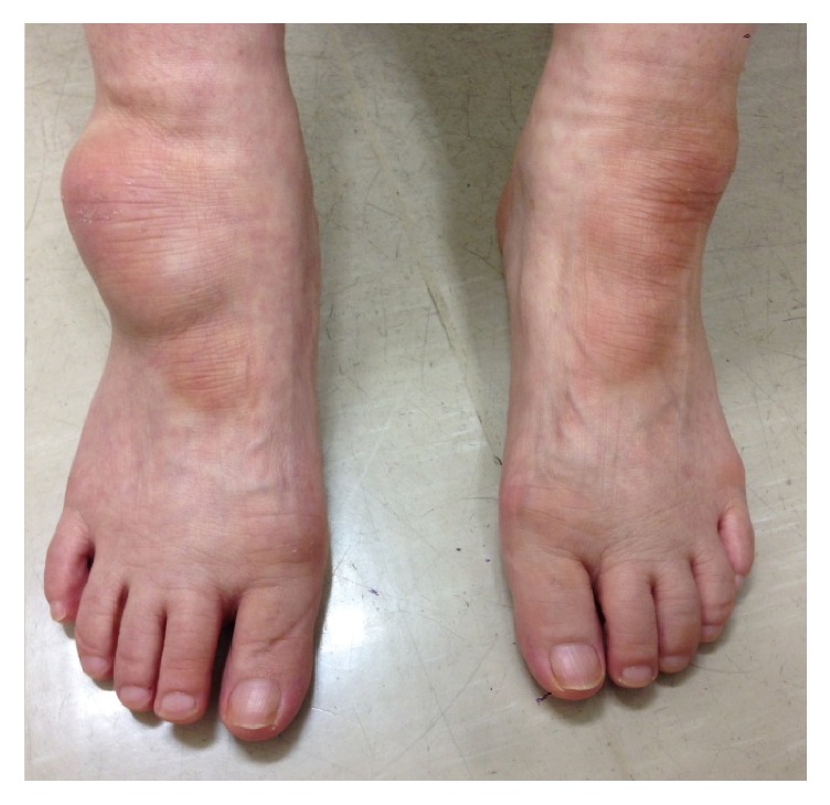 Recalcitrant Lateral Premalleolar Bursitis of the Ankle Associated with ...